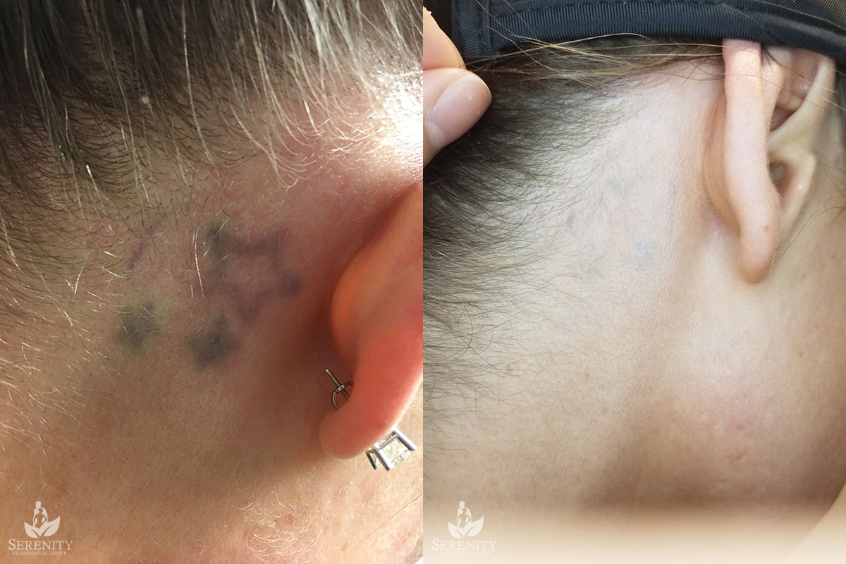 PicoSure Tattoo Removal Bellevue & Seattle