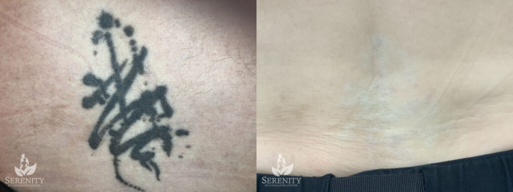 PicoSure Tattoo Removal before and after photo by Dr. Stephen O’Connell in Bellevue, WA