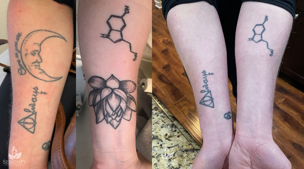 PicoSure Tattoo Removal Before & After Seattle, Bellevue Laser Tattoo Removal