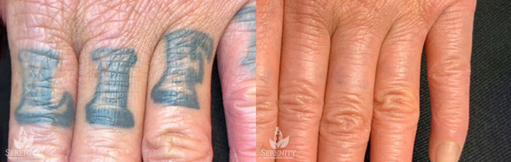 PicoSure Tattoo Removal before and after photo by Dr. Stephen O’Connell in Bellevue, WA