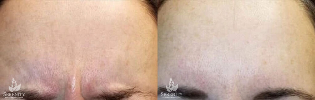 Botox before and after photo by Dr. Stephen O’Connell in Bellevue, WA