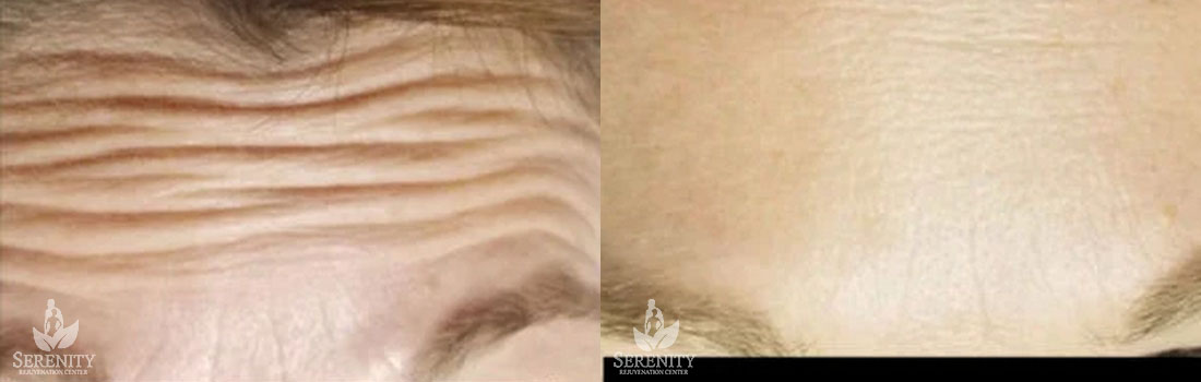 Botox before and after photo by Dr. Stephen O’Connell in Bellevue, WA