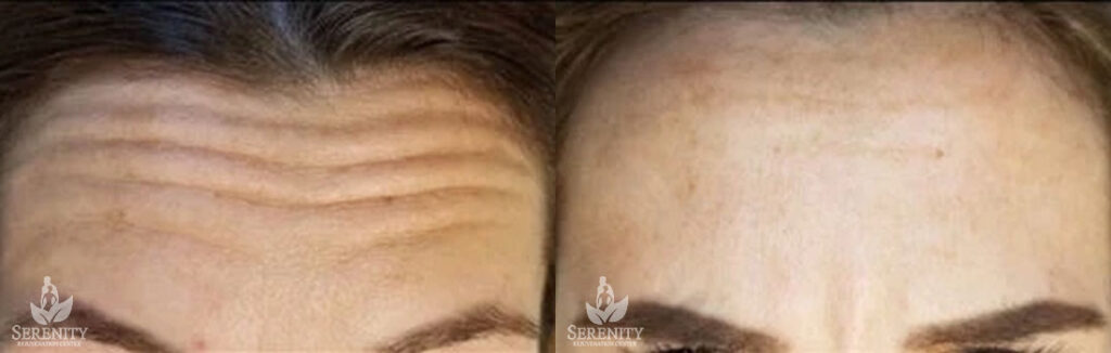 Botox before and after photo by Dr. Stephen O’Connell in Bellevue, WA