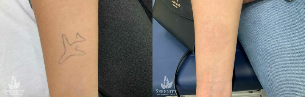 Top PicoSure Tattoo Removal in Seattle & Bellevue