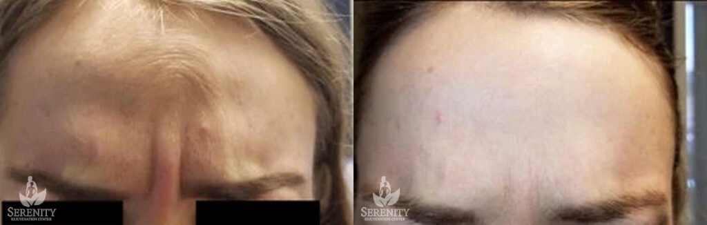 Botox before and after photo by Dr. Stephen O’Connell in Bellevue, WA