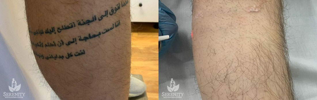 PicoSure Tattoo Removal before and after photo by Dr. Stephen O’Connell in Bellevue, WA