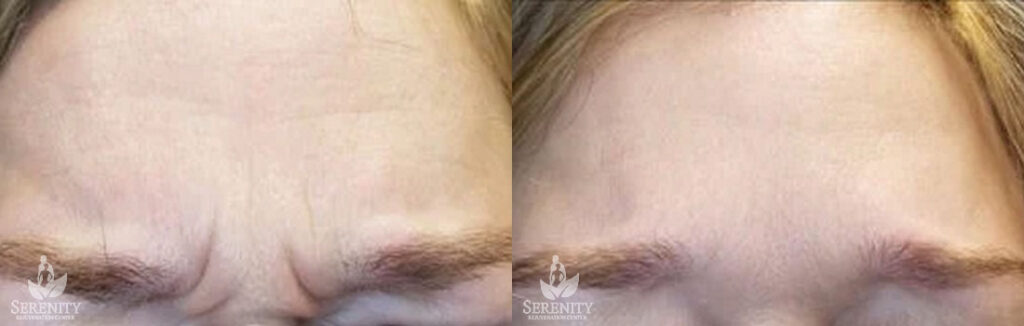 Botox before and after photo by Dr. Stephen O’Connell in Bellevue, WA