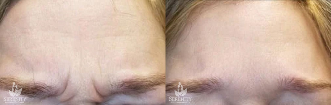 Botox before and after photo by Dr. Stephen O’Connell in Bellevue, WA