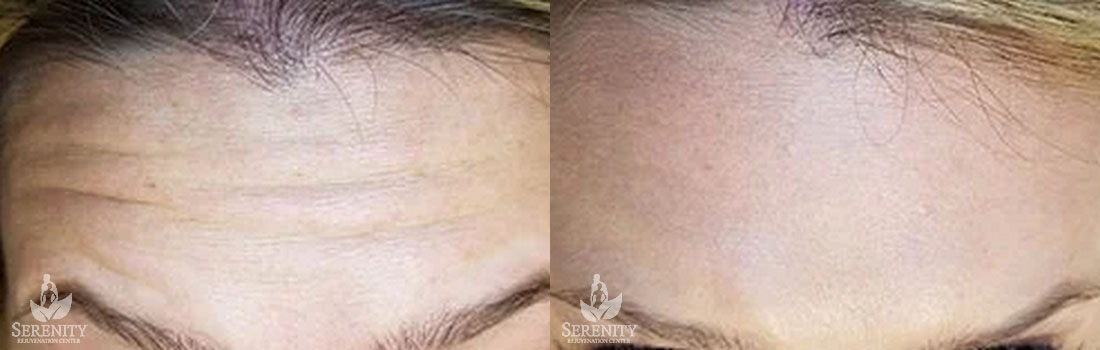 Botox before and after photo by Dr. Stephen O’Connell in Bellevue, WA