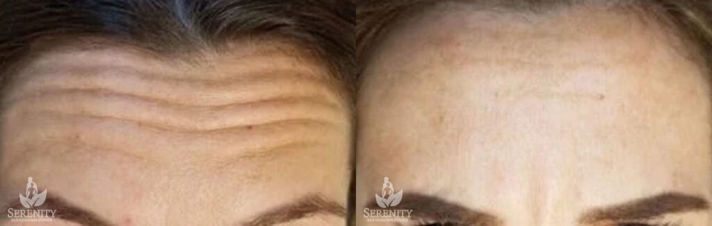 Botox Crow’s Feet Seattle, Eye Wrinkle Botox Bellevue, Botox Redmond