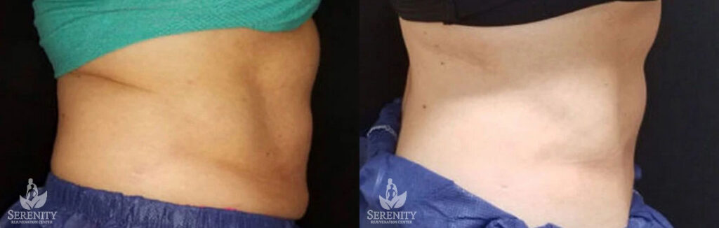 CoolSculpting Body Slimming Kirkland, Non Surgical Fat Loss Bellevue, Fat Freezing Seattle