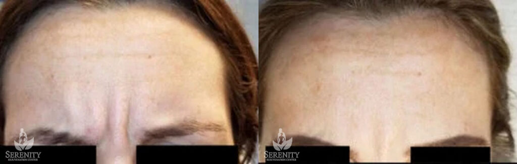 Botox before and after photo by Dr. Stephen O’Connell in Bellevue, WA