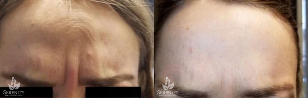 Botox before and after photo by Dr. Stephen O’Connell in Bellevue, WA
