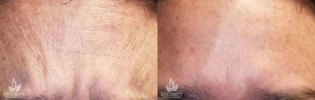 Botox before and after photo by Dr. Stephen O’Connell in Bellevue, WA