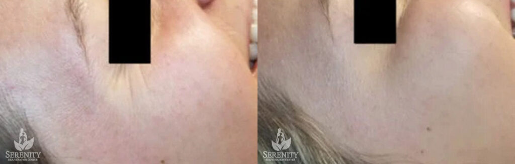 Botox Forehead Seattle, Botox Bellevue, Wrinkle Treatment Redmond