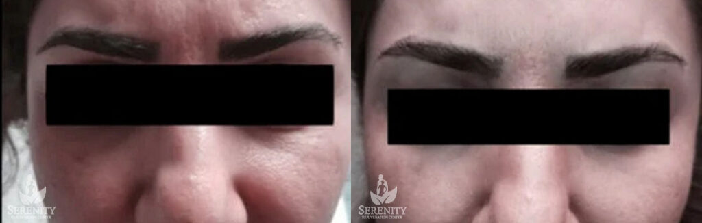 Botox Wrinkle Reduction – Before & After
