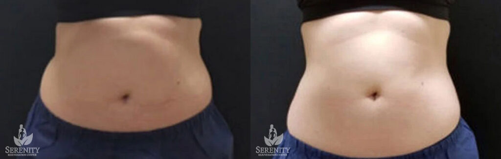 CoolSculpting Fat Reduction Bellevue, Body Contouring Seattle, Non Surgical Fat Removal Redmond