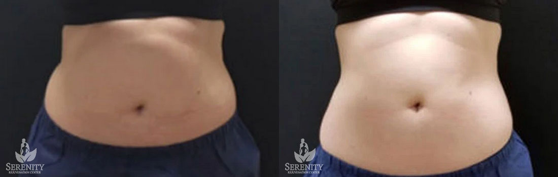 CoolSculpting before and after photo by Dr. Stephen O’Connell in Bellevue, WA