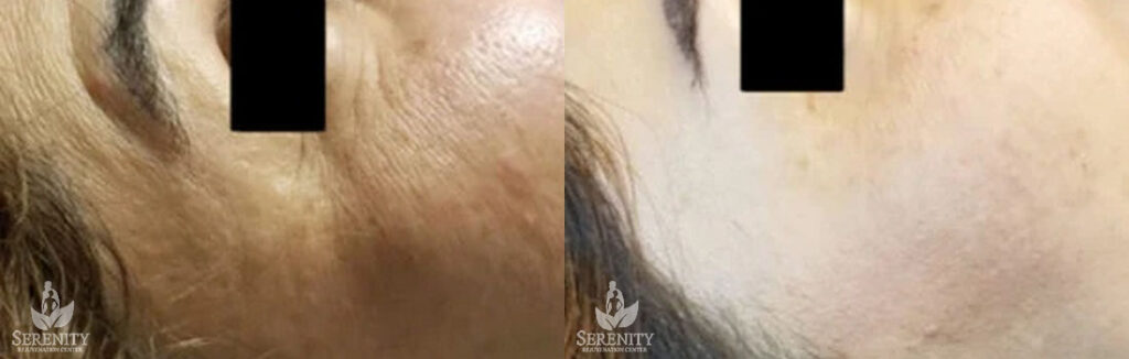 Botox before and after photo by Dr. Stephen O’Connell in Bellevue, WA