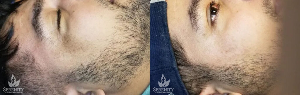 PicoFOCUS before and after photo by Dr. Stephen O’Connell in Bellevue, WA