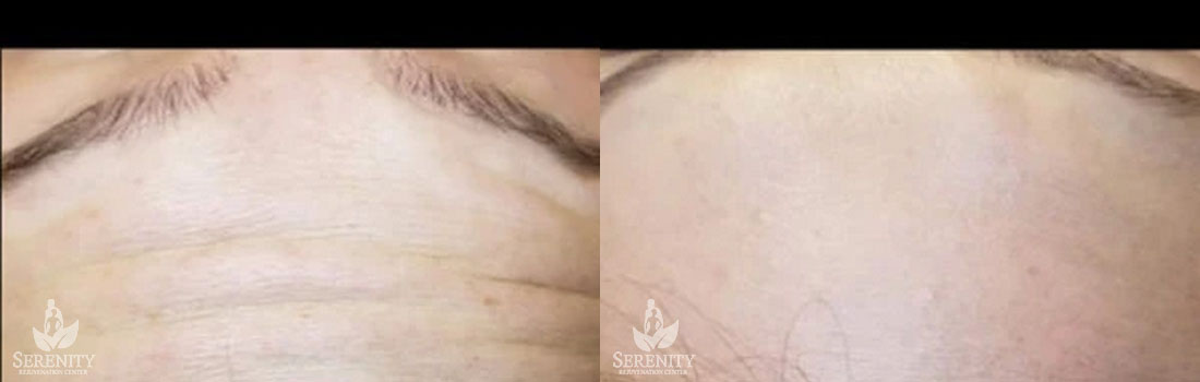 Botox before and after photo by Dr. Stephen O’Connell in Bellevue, WA