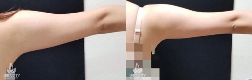 CoolSculpting Stomach Fat Reduction Seattle, Body Sculpting Bellevue, Fat Freezing Kirkland
