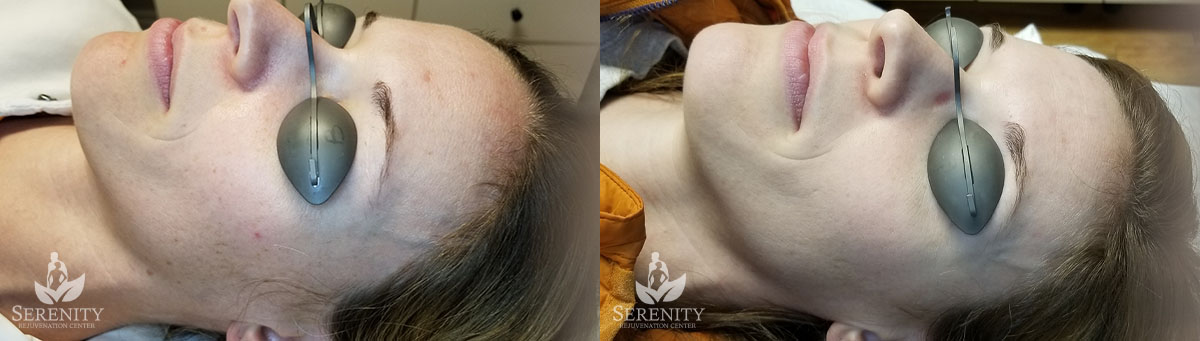 PicoSure® Pro Focus before and after photo by Dr. Stephen O’Connell in Bellevue, WA