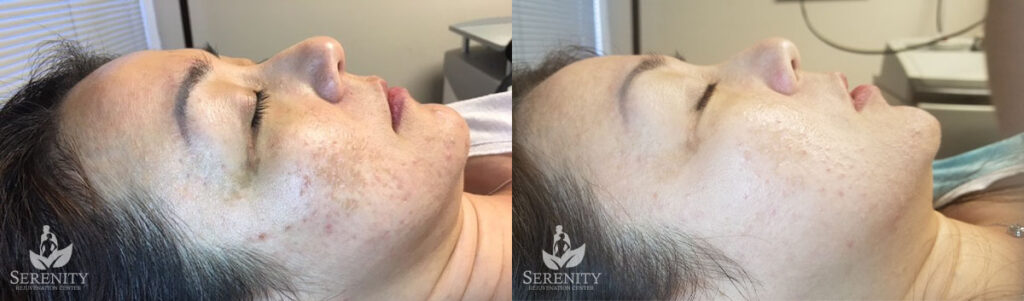 PicoFocus Treatment Redmond, Skin Brightening Bellevue, Laser Skin Therapy Seattle
