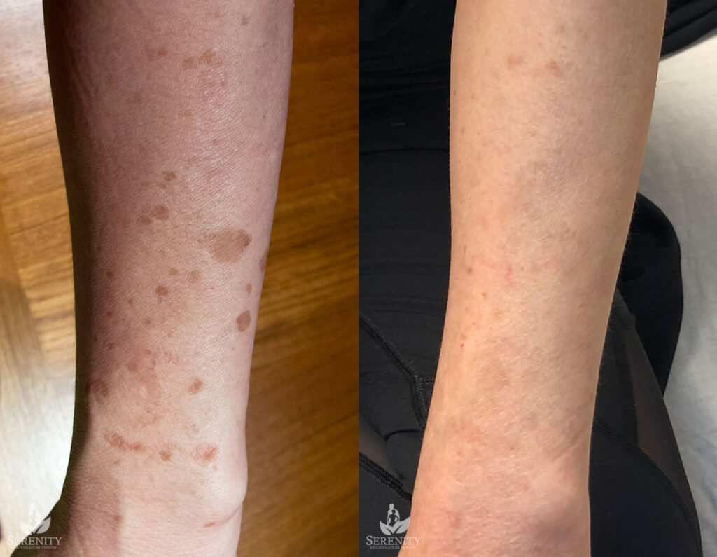 PicoFocus Skin Revitalization Bellevue, Laser Skin Correction Seattle, Pigmentation Redmond