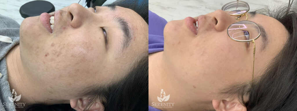 PicoSure® Pro Focus before and after photo by Dr. Stephen O’Connell in Bellevue, WA