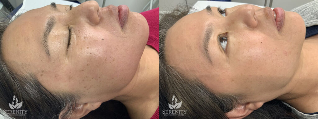 PicoSure® Pro Focus before and after photo by Dr. Stephen O’Connell in Bellevue, WA