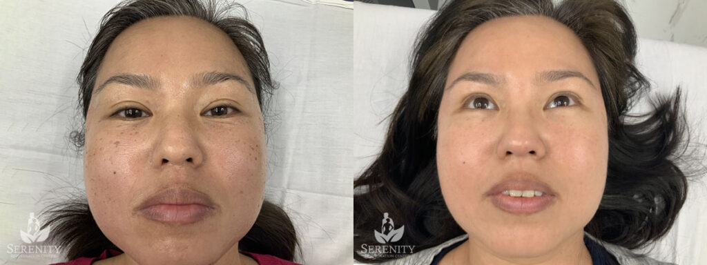 PicoSure® Pro Focus before and after photo by Dr. Stephen O’Connell in Bellevue, WA