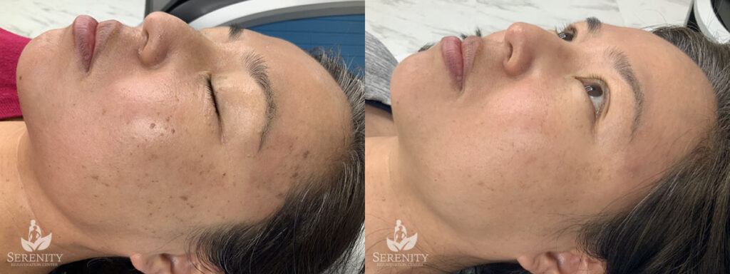 PicoFocus Laser Resurfacing in Bellevue & Seattle