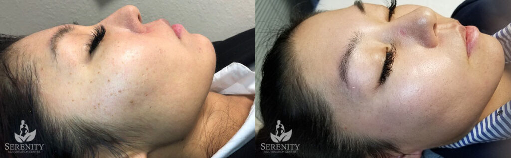 PicoSure® Pro Focus before and after photo by Dr. Stephen O’Connell in Bellevue, WA