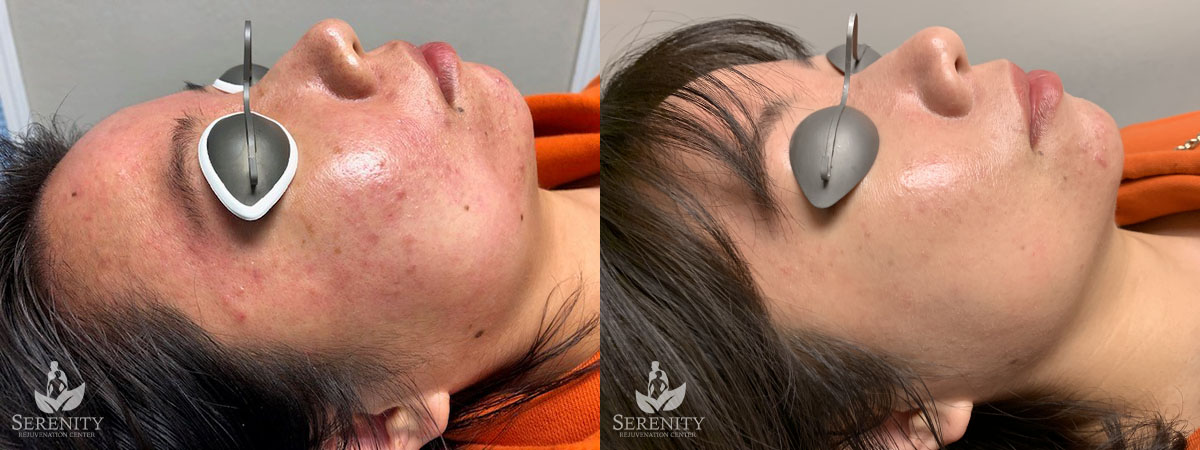 PicoSure® Pro Focus before and after photo by Dr. Stephen O’Connell in Bellevue, WA