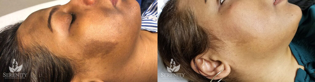 PicoSure® Pro Focus before and after photo by Dr. Stephen O’Connell in Bellevue, WA