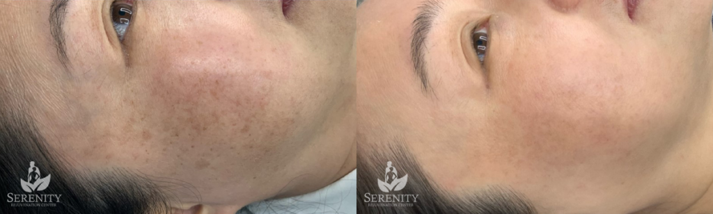 PicoSure® Pro Focus before and after photo by Dr. Stephen O’Connell in Bellevue, WA