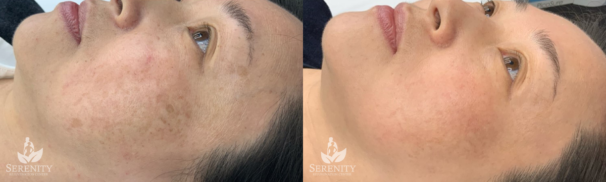 PicoSure® Pro Focus before and after photo by Dr. Stephen O’Connell in Bellevue, WA