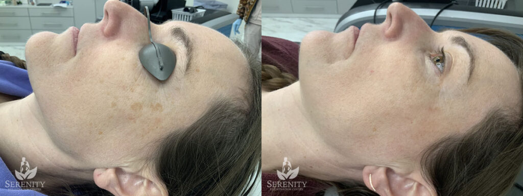 PicoFocus Laser Treatments in Bellevue & Seattle