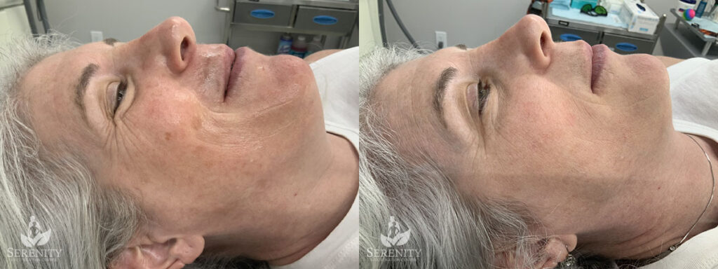 PicoFocus Skin Rejuvenation in Bellevue, Seattle & Redmond