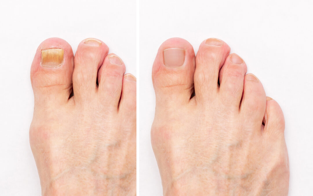 Conquering Onychomycosis: Understanding, Prevention, and Treatment