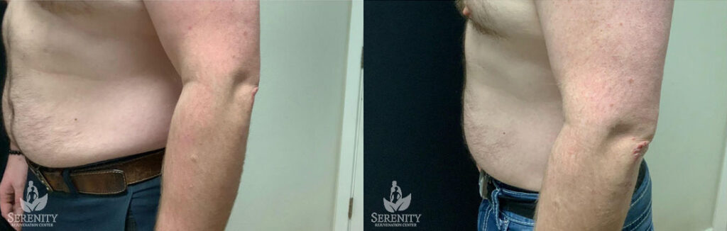 CoolSculpting Treatment Seattle, Fat Freezing Bellevue, Body Slimming Kirkland