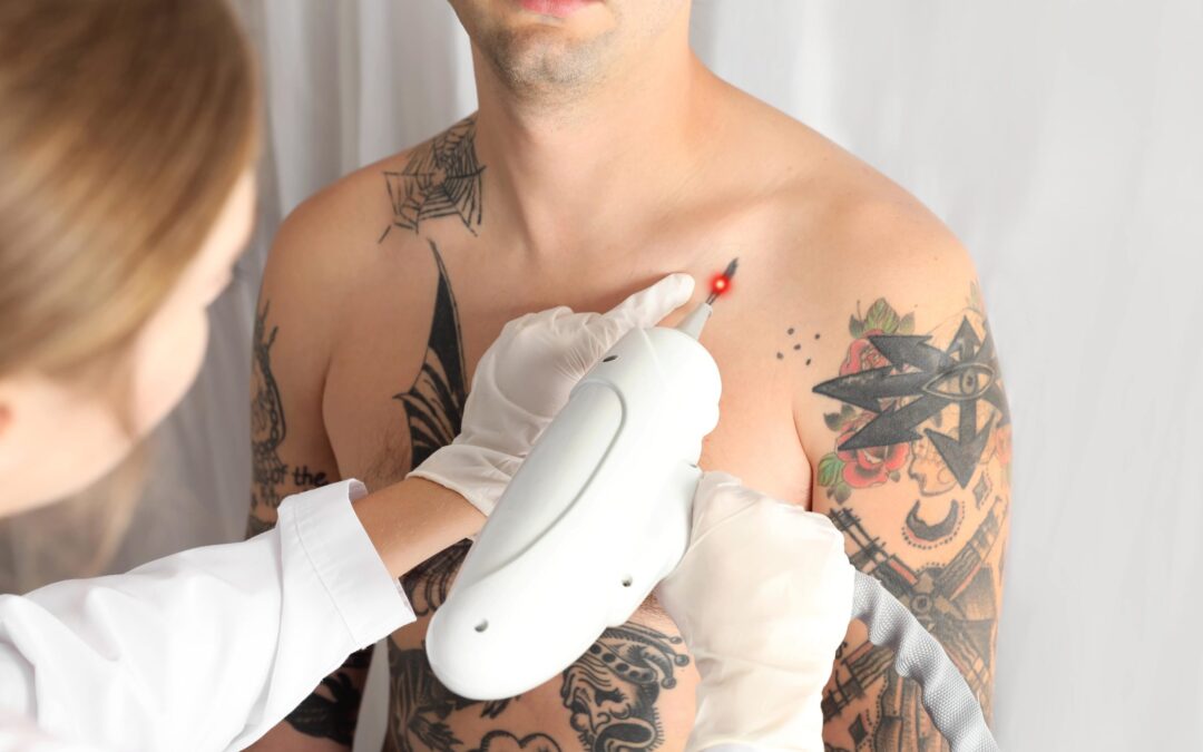 Potential Risks and Benefits of Tattoo Removal