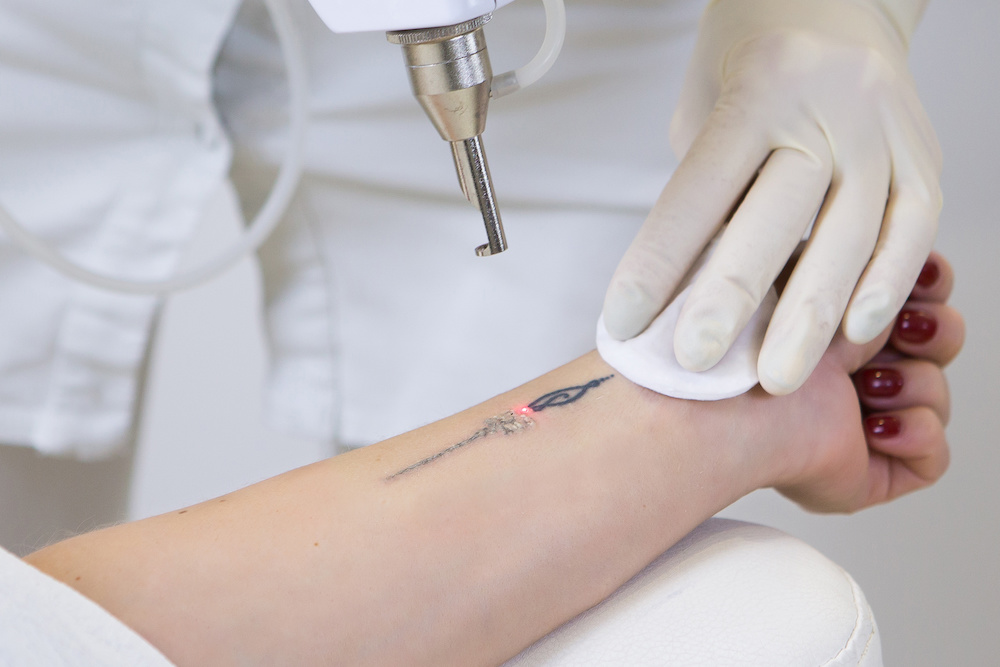 picosure laser tattoo removal