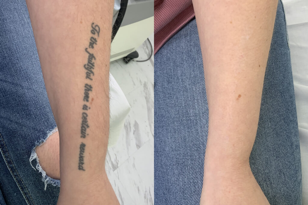 Laser Tattoo Removal with PicoSure in Seattle & Bellevue