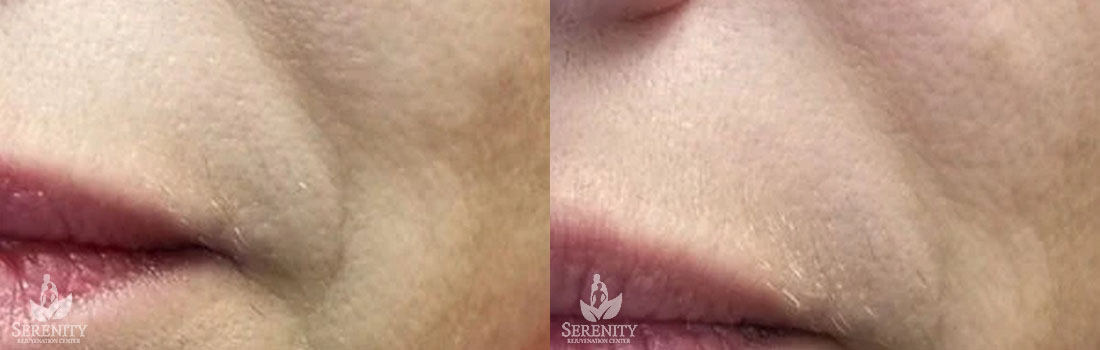 Dermal Fillers before and after photo by Dr. Stephen O’Connell in Bellevue, WA