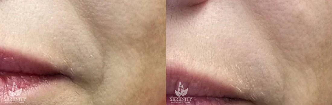 Marionette Line Fillers for Wrinkle Reduction in Seattle