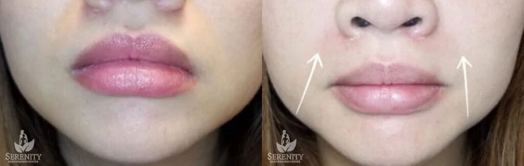 Chin & Jawline Fillers in Bellevue, Seattle & Redmond