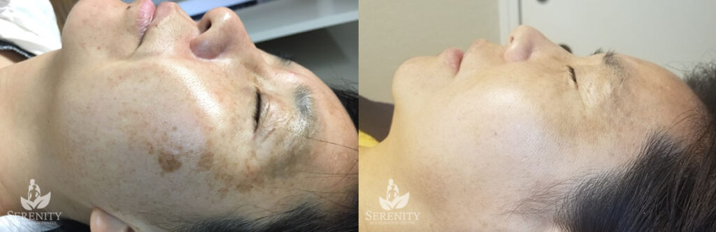 PicoFocus Skin Rejuvenation in Bellevue & Seattle