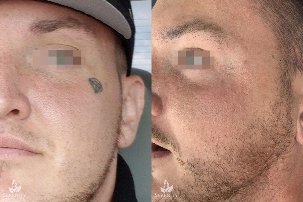 PicoSure Tattoo Removal before and after photo by Dr. Stephen O’Connell in Bellevue, WA